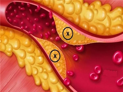 Quả bưởi non chữa mỡ máu – Bí quyết để sống khỏe mỗi ngày