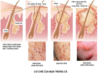 Sử dụng Vitamin trị mụn nên hay không? 