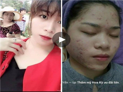 Chuyên gia giải đáp: mỡ trăn trị sẹo có hiệu quả không